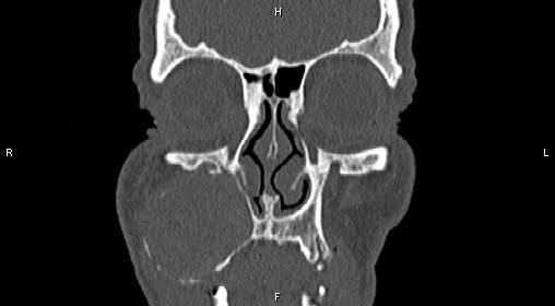 File:Central giant cell granuloma (Radiopaedia 83346-97761 Coronal bone window 7).jpg