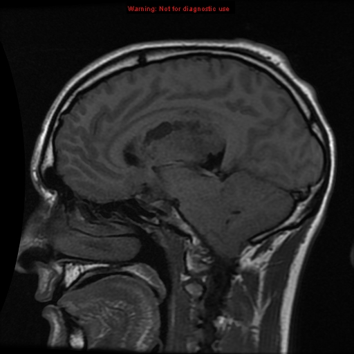 File:Central neurocytoma (Radiopaedia 13188-13206 Sagittal T1 10).jpg