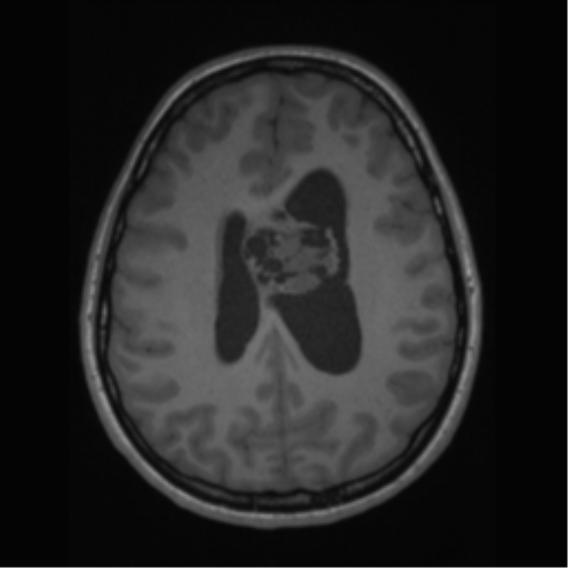 File:Central neurocytoma (Radiopaedia 37664-39557 Axial T1 48).png