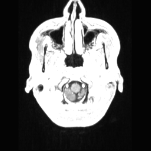 File:Central neurocytoma (Radiopaedia 37664-39557 Axial T1 C+ 9).png