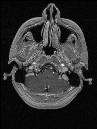 Central neurocytoma (Radiopaedia 56690-63469 Axial T1 C+ 26).jpg