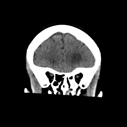 File:Central neurocytoma (Radiopaedia 65317-74346 Coronal non-contrast 17).png