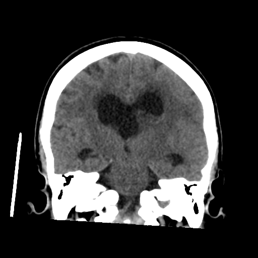 File:Central neurocytoma (Radiopaedia 65317-74346 Coronal non-contrast 33).png