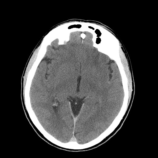 File:Central neurocytoma (Radiopaedia 68725-78432 Axial C+ 34).jpg