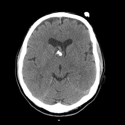 Central neurocytoma (Radiopaedia 68725-78432 Axial non-contrast 23).jpg