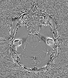 Central neurocytoma (Radiopaedia 84497-99872 Axial 22).jpg