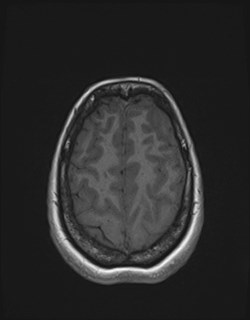 File:Central neurocytoma (Radiopaedia 84497-99872 Axial T1 160).jpg