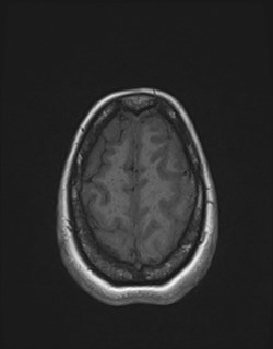 Central neurocytoma (Radiopaedia 84497-99872 Axial T1 164).jpg