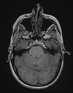 Central neurocytoma (Radiopaedia 84497-99872 Axial T1 64).jpg