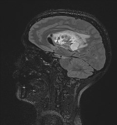 Central neurocytoma (Radiopaedia 84497-99872 Sagittal Flair + Gd 68).jpg
