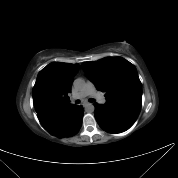 Centrilobular pulmonary emphysema (Radiopaedia 24495-24789 Axial non-contrast 23).jpg