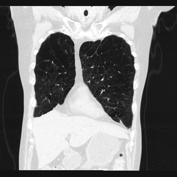 Centrilobular pulmonary emphysema (Radiopaedia 24495-24789 Coronal lung window 15).jpg
