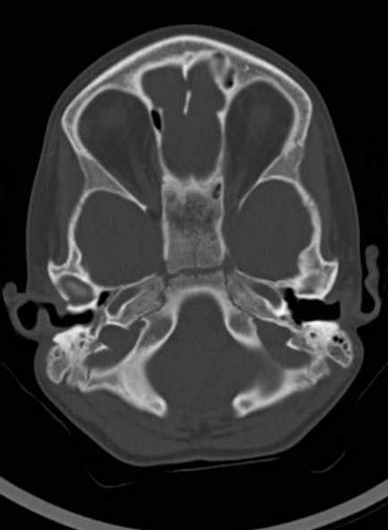 Cerebellar abscess (Radiopaedia 73727-84527 Axial bone window 23).jpg