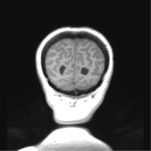 Cerebellar ependymoma complicated by post-operative subdural hematoma (Radiopaedia 83322-97736 Coronal T1 52).png