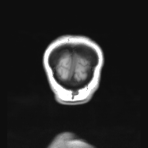 Cerebellar ependymoma complicated by post-operative subdural hematoma (Radiopaedia 83322-97736 Coronal T1 57).png