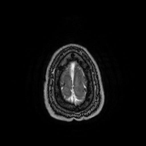Cerebellar hemangioblastoma (Radiopaedia 88055-104622 Axial T1 C+ 161).jpg
