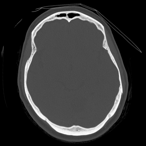 Cerebellar metastasis (cystic appearance) (Radiopaedia 41395-44258 Axial bone window 28).png