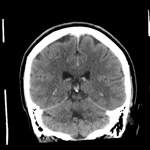 Cerebellar metastasis (cystic appearance) (Radiopaedia 41395-44258 D 40).png