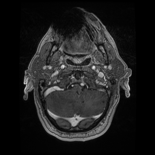 Cerebellar metastasis of pulmonary adenocarcinoma, cavernous venous malformation, and developmental venous anomaly (Radiopaedia 85827-101661 Axial T1 C+ 19).jpg