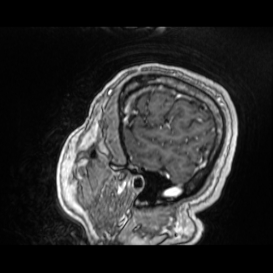 Cerebellar metastasis of pulmonary adenocarcinoma, cavernous venous malformation, and developmental venous anomaly (Radiopaedia 85827-101661 Sagittal T1 C+ 19).jpg