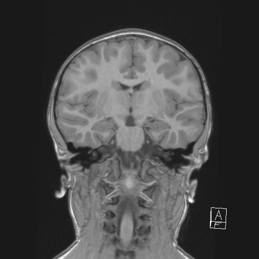 Cerebellar stroke (Radiopaedia 32202-33150 Coronal T1 31).png