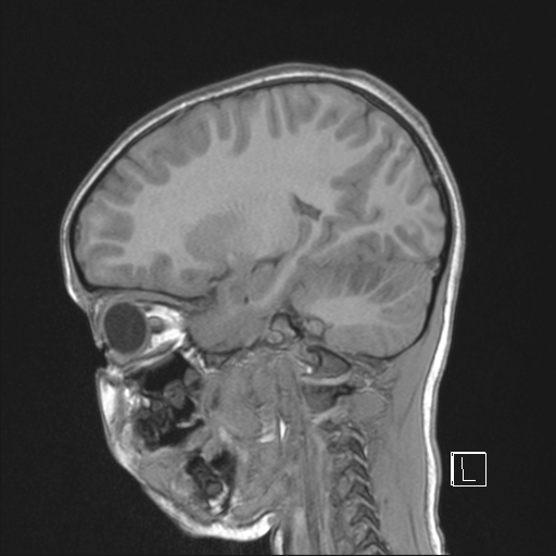 Cerebellar stroke (Radiopaedia 32202-33150 Sagittal T1 C+ 18).png