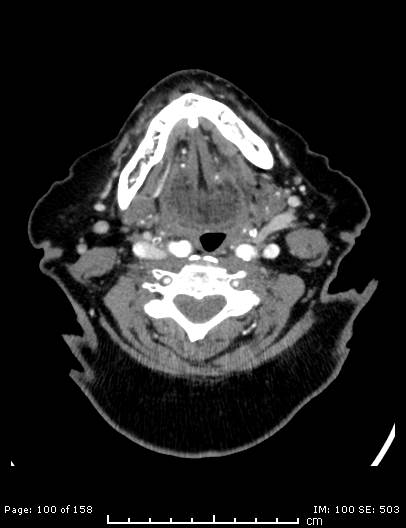 Cerebellar strokes due to intracranial giant cell arteritis (Radiopaedia 68799-78510 CT angiogram 100).jpg