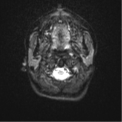 Cerebellar tuberculomas (Radiopaedia 46939-51472 Axial DWI 1).png
