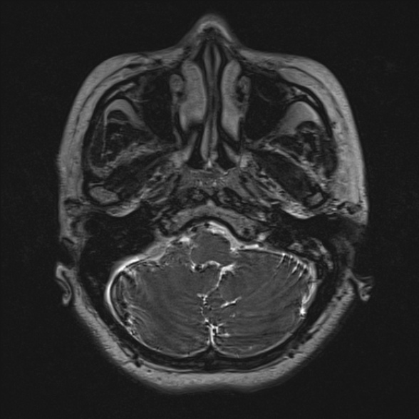 File:Cerebellopontine angle meningioma (Radiopaedia 53561-59591 Axial 3D volume T2 36).jpg