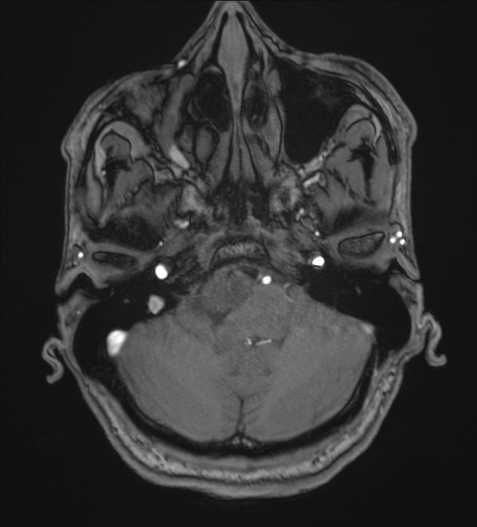 Cerebellopontine angle meningioma (Radiopaedia 72983-83680 Axial MRA 18).jpg