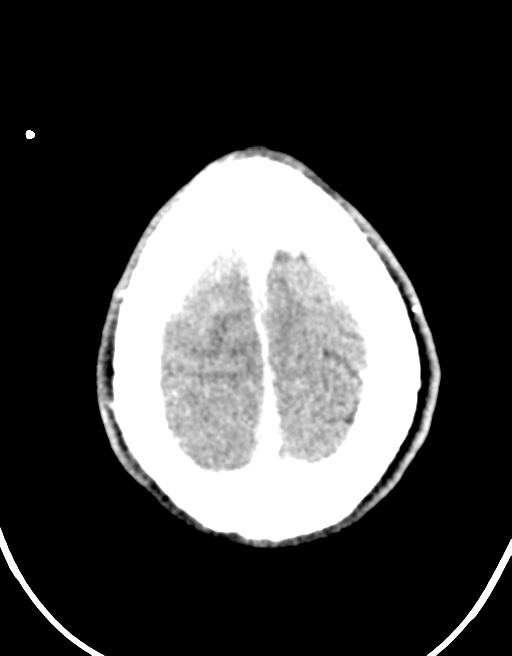 Cerebral abscess (Radiopaedia 60342-68008 Axial C+ delayed 46).png