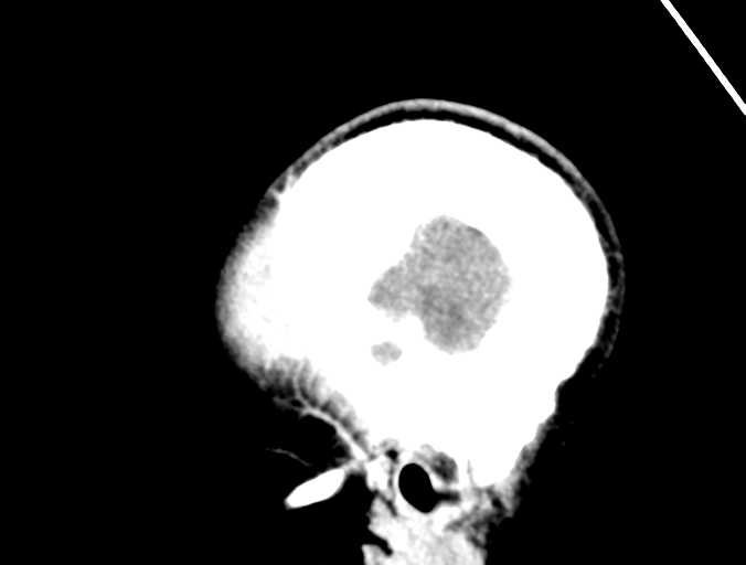 Cerebral abscess (Radiopaedia 60342-68008 Sagittal C+ delayed 5).png