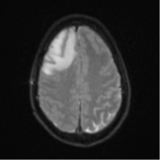 Cerebral abscess (Radiopaedia 60342-68009 Axial DWI 27).png