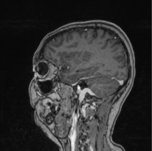 Cerebral abscess from pulmonary arteriovenous malformation (Radiopaedia 86275-102291 Sagittal T1 C+ 24).png