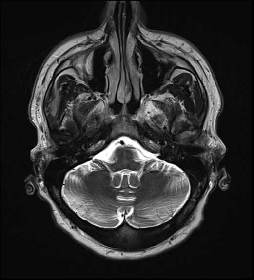 File:Cerebral abscess with ventriculitis (Radiopaedia 78965-91878 Axial T2 10).jpg