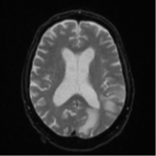 Cerebral abscesses- medically managed (Radiopaedia 45183-49179 Axial DWI 17).png