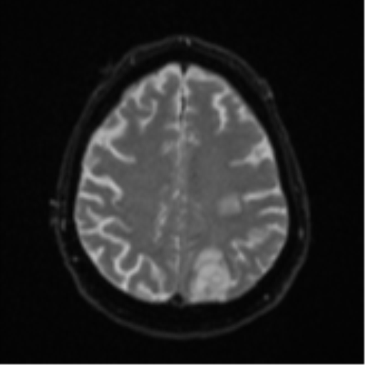 Cerebral abscesses- medically managed (Radiopaedia 45183-49179 Axial DWI 21).png