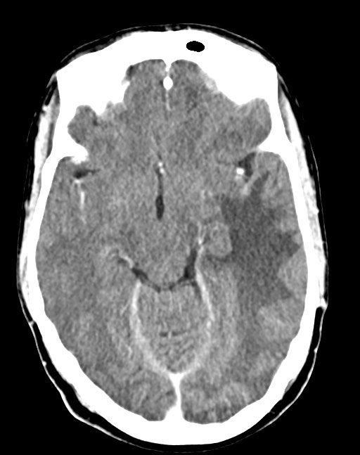 Cerebral abscesses (Radiopaedia 70458-80568 Axial Contrast 27).jpg