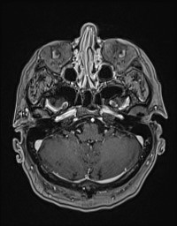Cerebral amyloid angiopathy-related inflammation (Radiopaedia 58270-65377 Axial T1 C+ fat sat 22).jpg
