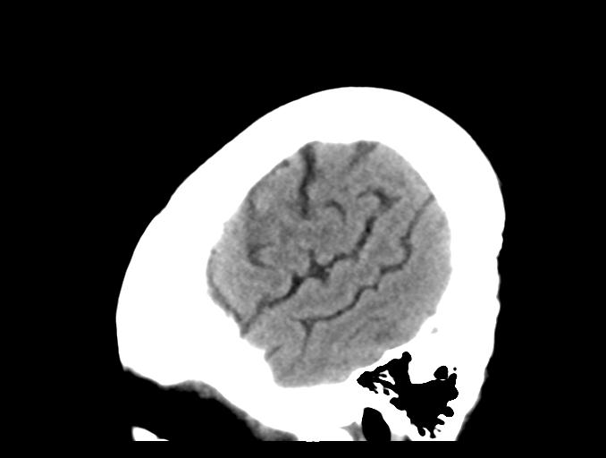 File:Cerebral aneurysm with rupture (Radiopaedia 29933-30457 B 5).jpg