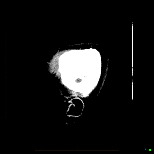Cerebral arteriovenous malformation (AVM) (Radiopaedia 78162-90706 A 72).jpg