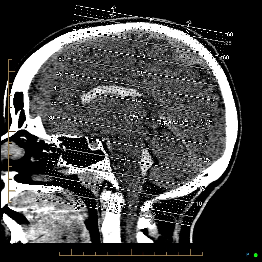 Cerebral arteriovenous malformation (AVM) (Radiopaedia 78162-90706 Coronal non-contrast 1).jpg