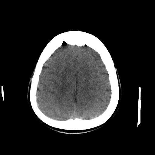 Cerebral arteriovenous malformation (Radiopaedia 28518-28759 Axial non-contrast 57).jpg