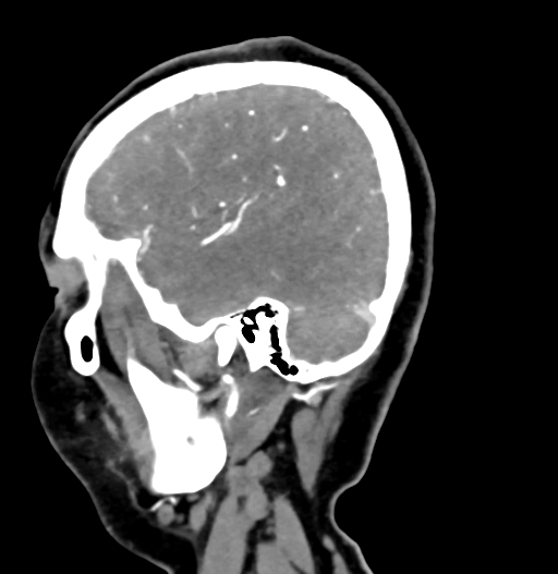 Cerebral arteriovenous malformation (Radiopaedia 73830-84645 D 74).jpg
