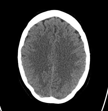 File:Cerebral arteriovenous malformation (Radiopaedia 74411-85744 Axial non-contrast 23).jpg