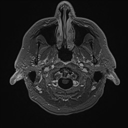 Cerebral arteriovenous malformation (Radiopaedia 84015-99245 Axial T1 C+ 16).jpg
