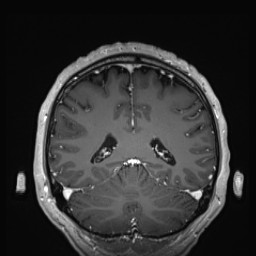 Cerebral arteriovenous malformation (Radiopaedia 84015-99245 Coronal T1 C+ 114).jpg