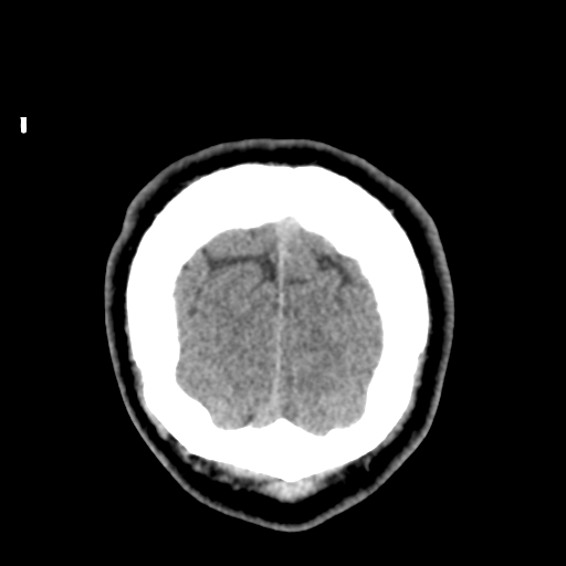 Cerebral arteriovenous malformation (Spetzler-Martin grade 2) (Radiopaedia 41262-44076 Coronal non-contrast 61).png