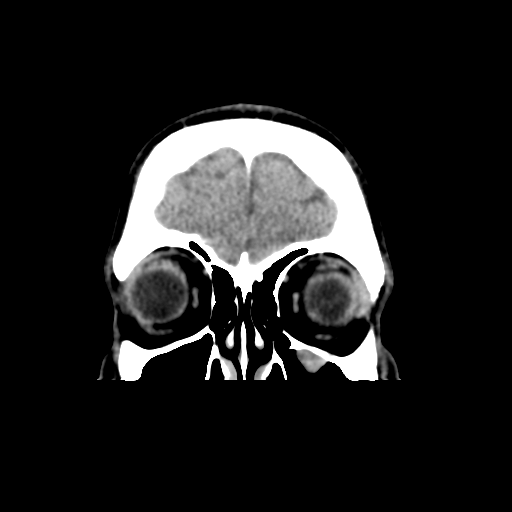 File:Cerebral arteriovenous malformation (Spetzler-Martin grade 2) (Radiopaedia 41262-44076 Coronal non-contrast 8).png