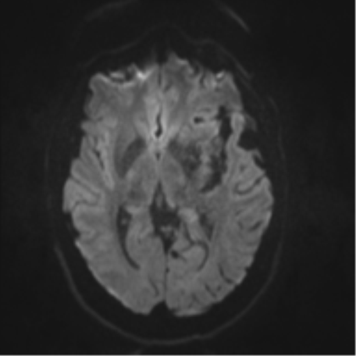 File:Cerebral arteriovenous malformation - huge (Radiopaedia 35734-37272 Axial DWI 34).png